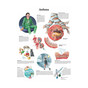Chart Understanding Asthma, Each Each