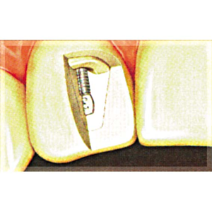 Op Po Precious Posts Beige 1.50mm 10/pk Pack