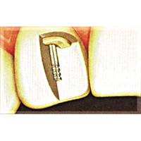 Op Po Temporary Posts Grey 1.0mm 20/pk Pack